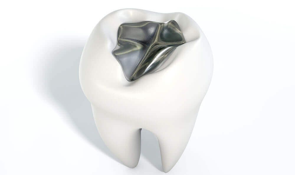 amalgam fillings in teeth
