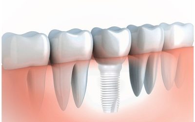 Smile Restoration Options