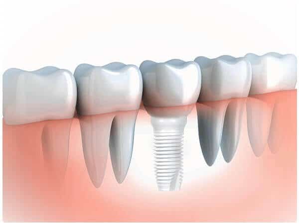 Smile Restoration Options