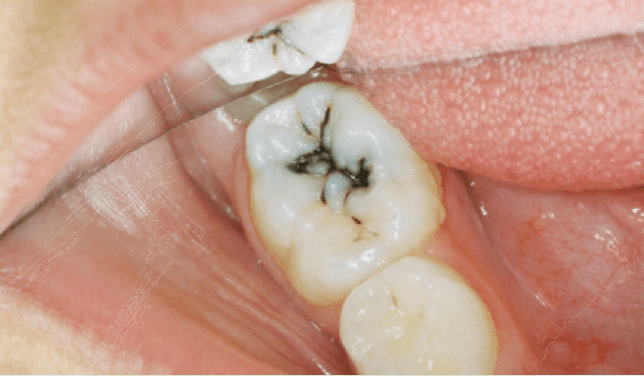 Silver nitrate Tooth Silver Nitrate Trails