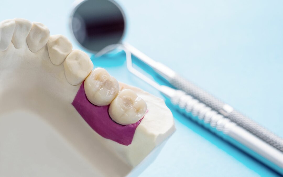 crowns that will be necessary for a tooth restoration