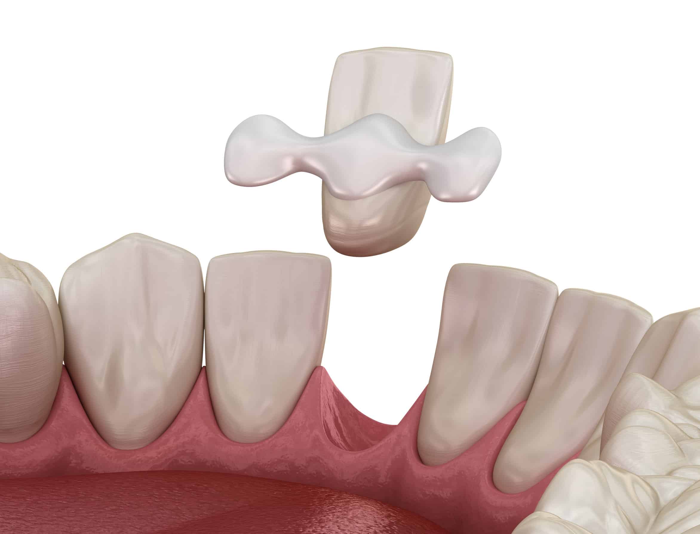 bonded dental bridge illustration