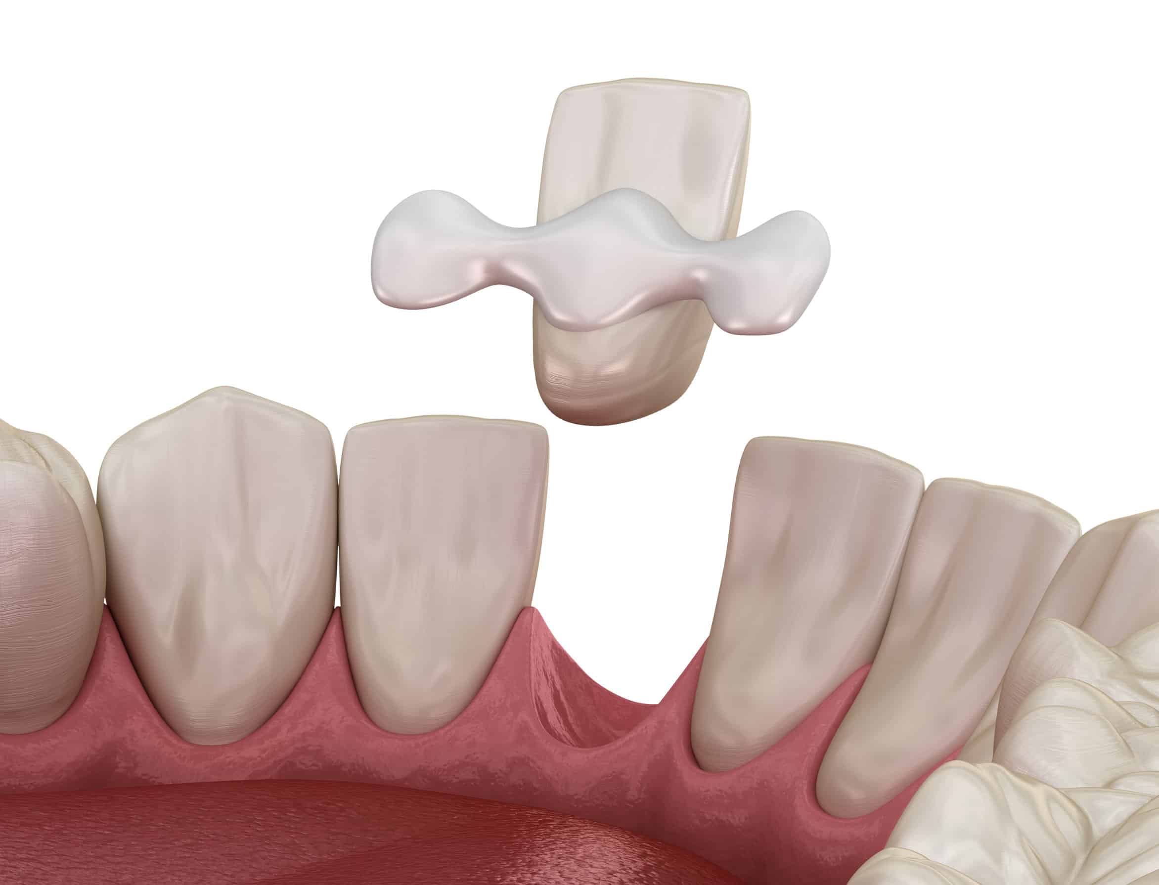 Bonded bridge bonded dental bridge illustration