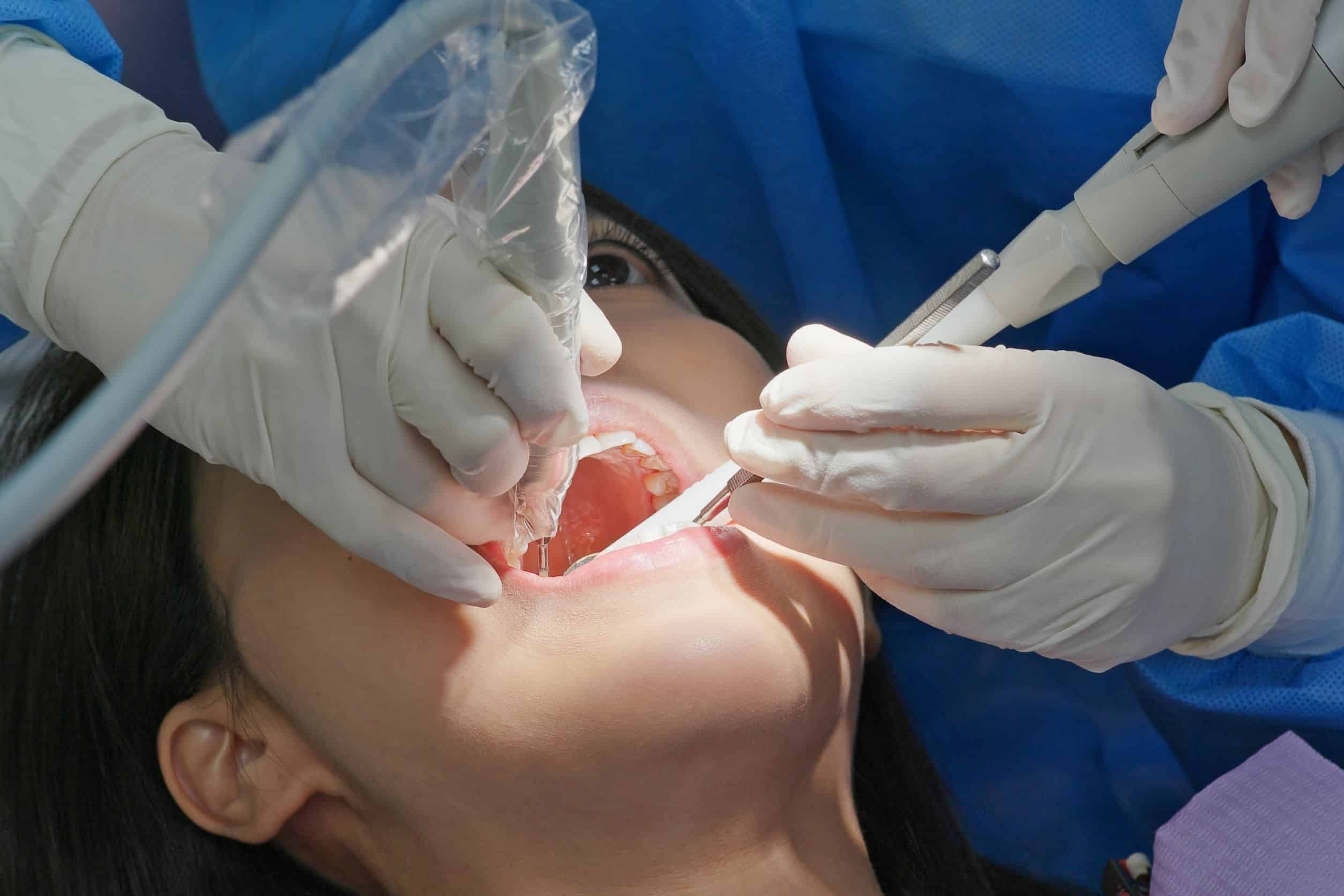 dental scaling woman undergoing a dental scaling procedure