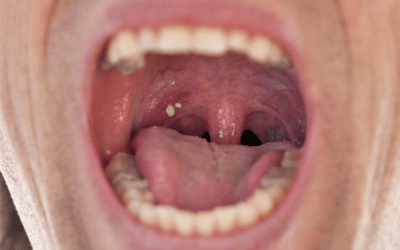 Tonsil Stones and Your Health