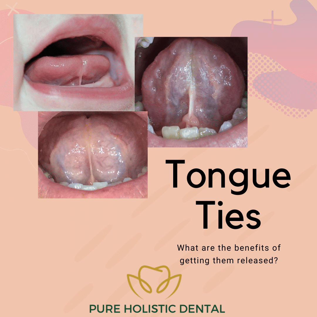Tongue Tie