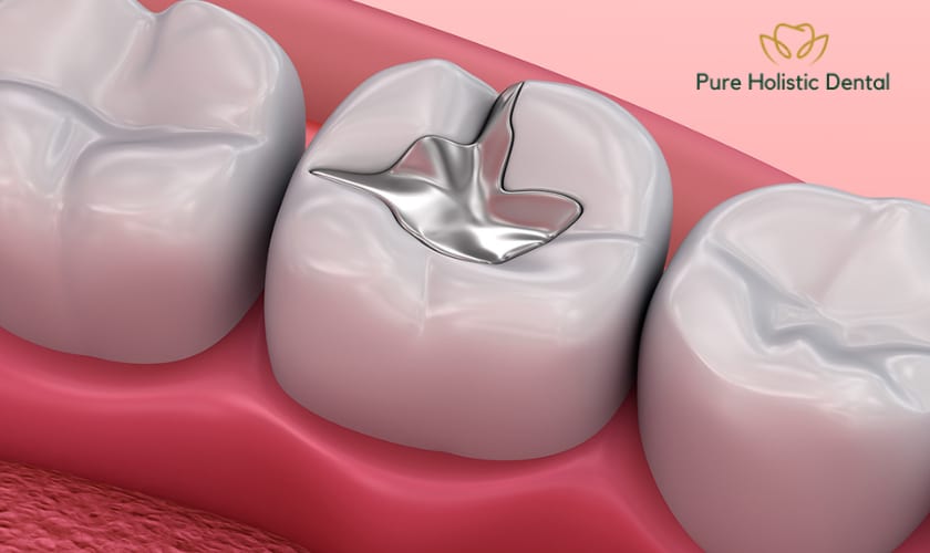 Mercury fillings in Teeth