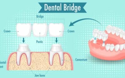 Beyond Missing Teeth: Embracing the Benefits of Dental Bridges Restorations