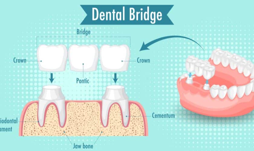 Dental Bridges Restorations