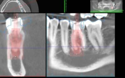 Revolutionizing Dental Care with Laser Dentistry: Unveiling the Future of Oral Healthcare