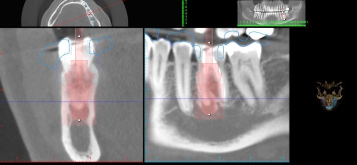 Dental Care with Laser Dentistry - Pure Holistic Dental