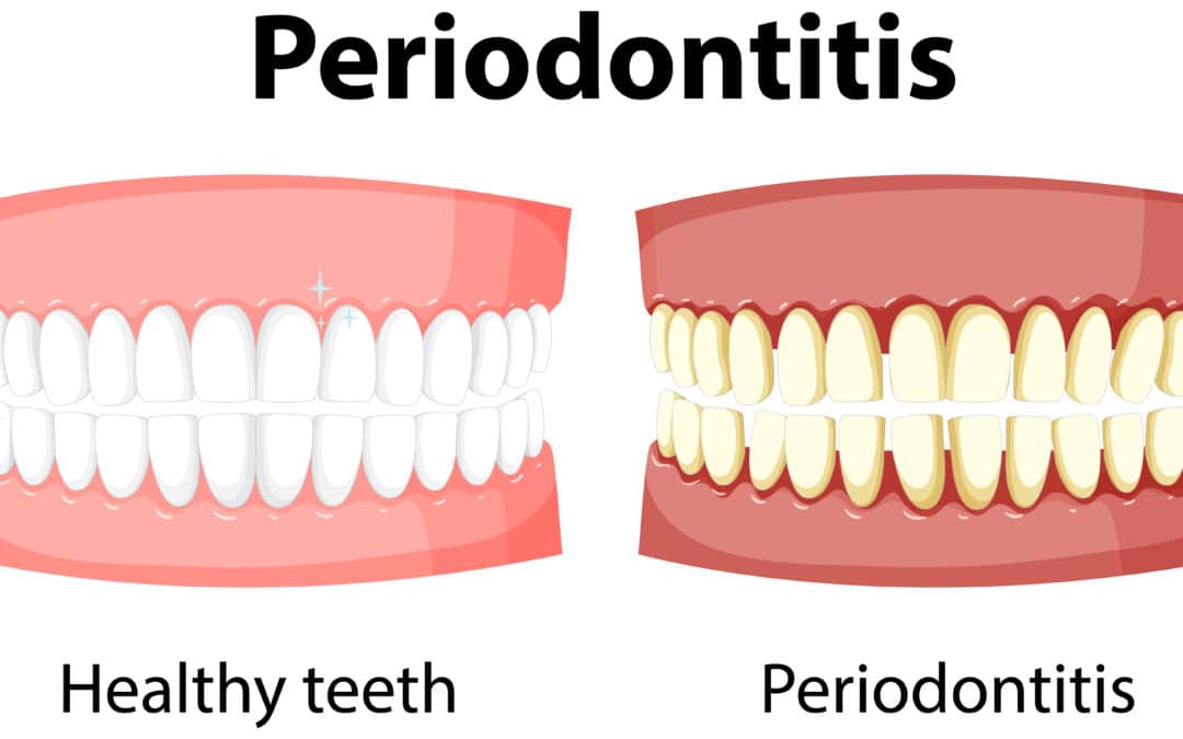 Scaling and Root Planing - Pure Holistic Dental