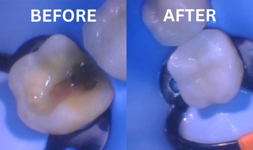 Biomimetic Fillings Before and After