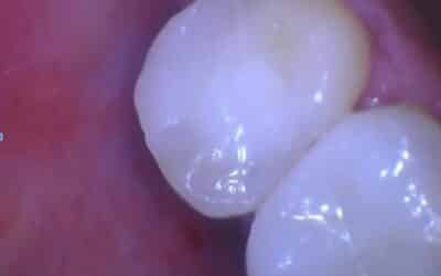 A Natural Approach to Dental Health: Exploring Biomimetic Fillings