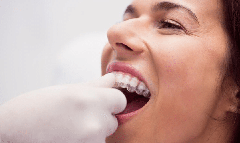 Mastering the Art of Clear Aligner Care