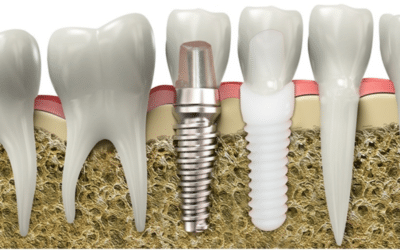 Everything You Need To Know About Zirconia Implants