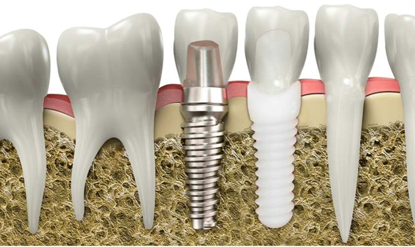know about zirconia implants