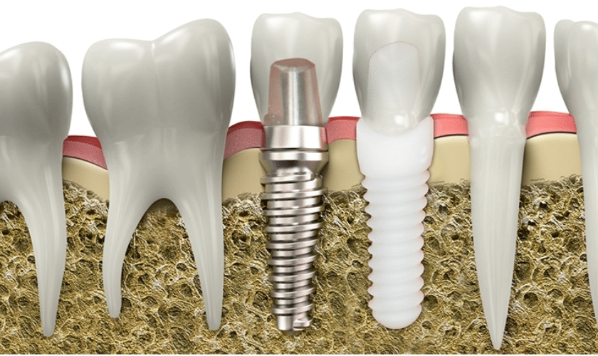 Everything You Need To Know About Zirconia Implants