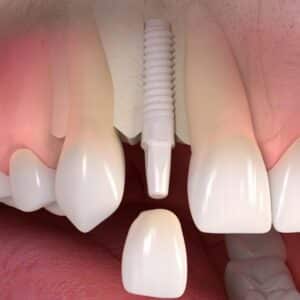 Zirconia Implant Procedure