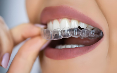 What Clear Aligners Do to Your Teeth? Impact on Oral Health