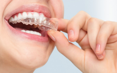 Clear Aligners & Your Smile: How They Improve Oral Health
