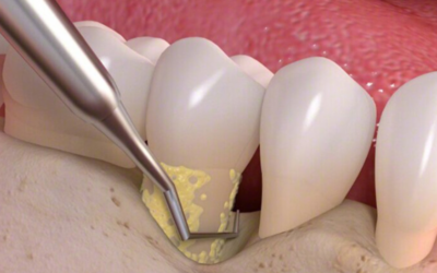 Scaling & Root Planing: Your Best Defense Against Gum Disease