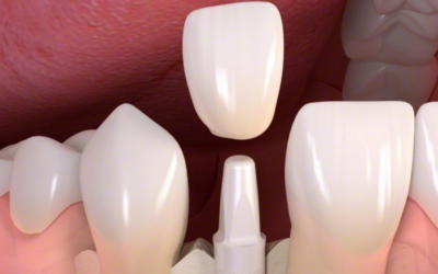 Zirconia Implants 101: Everything You Should Know Before Choosing Them